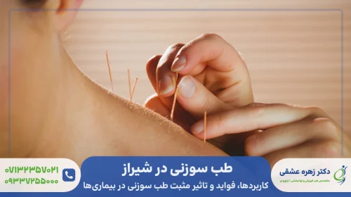 طب سوزنی در شیراز [توسط پزشک متخصص]