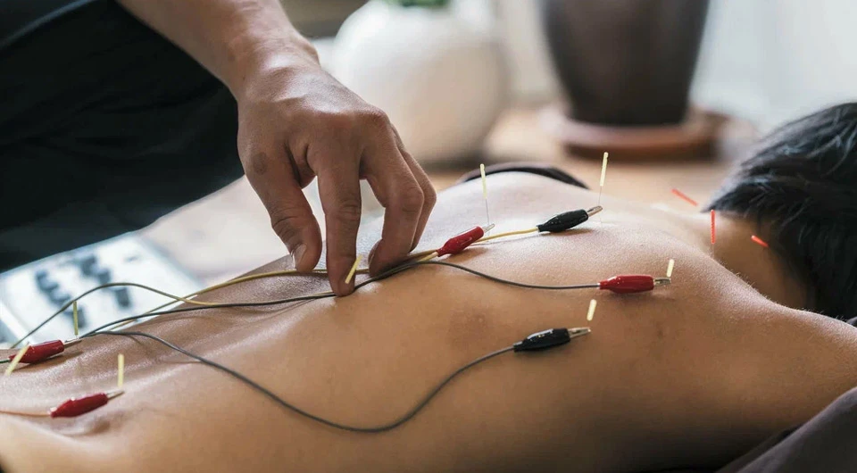 الکترواکوپانکچر