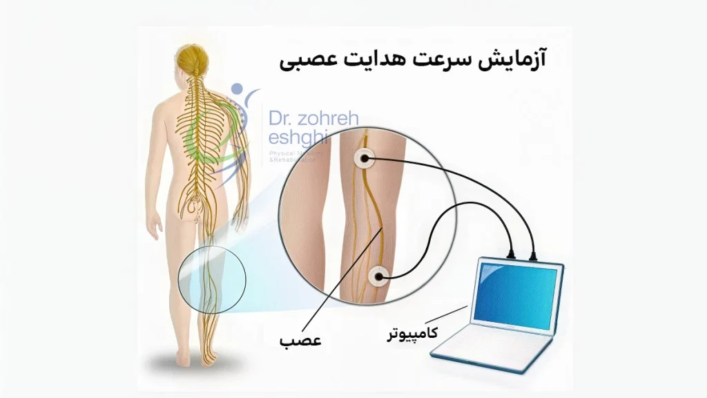 تست سرعت هدایت عصبی