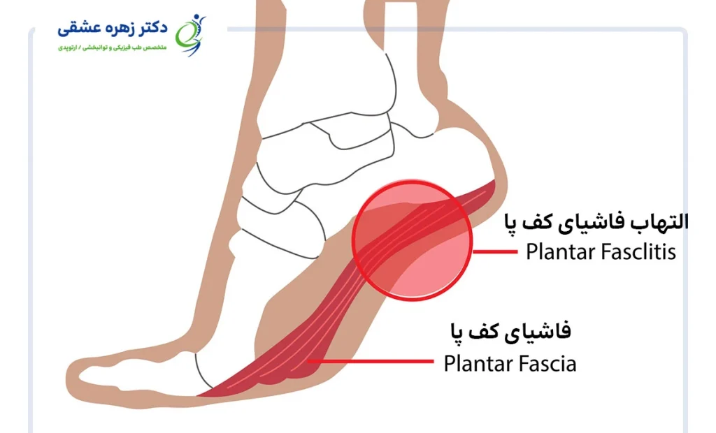 التهاب فاشیا پلانتار