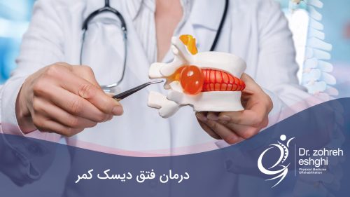 فتق دیسک کمر
