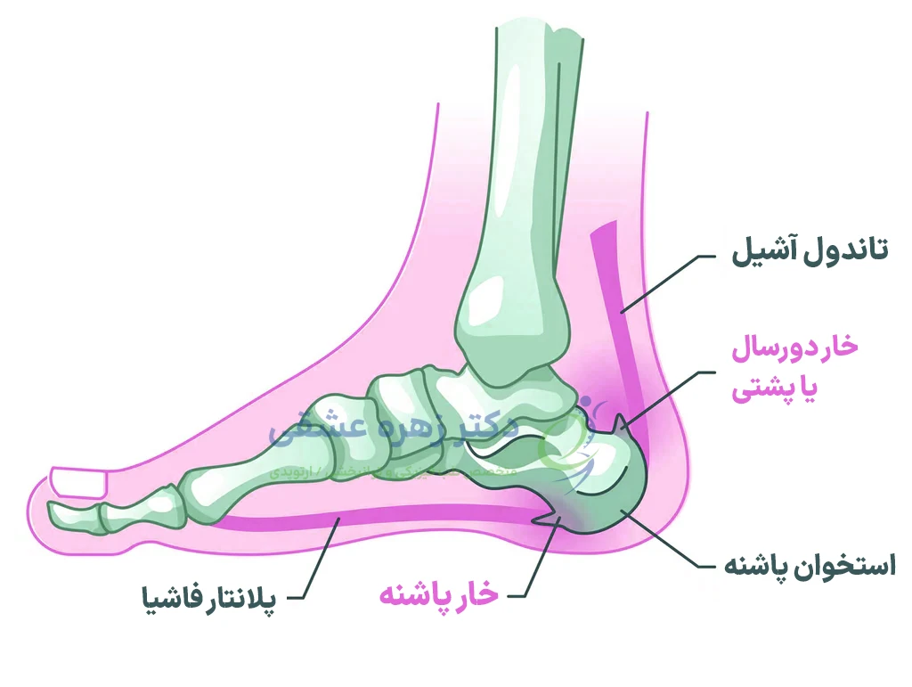 آناتومی خار پاشنه