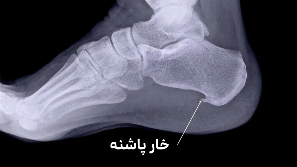 علائم خار پاشنه روی عکس سی تی اسکن