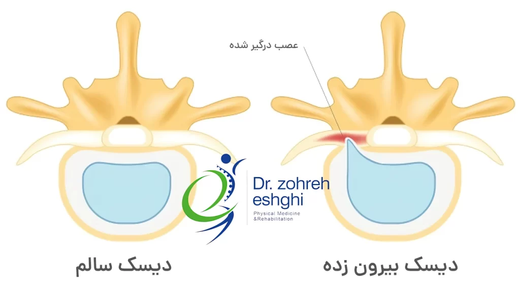 دیسک بیرون زده یا فتق دیسک کمر