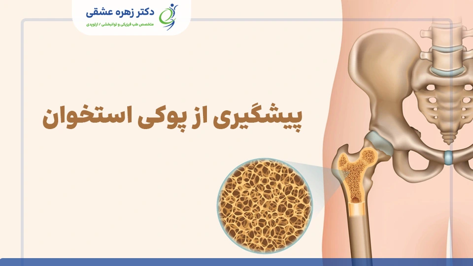 پیشگیری از عارضه پوکی استخوان