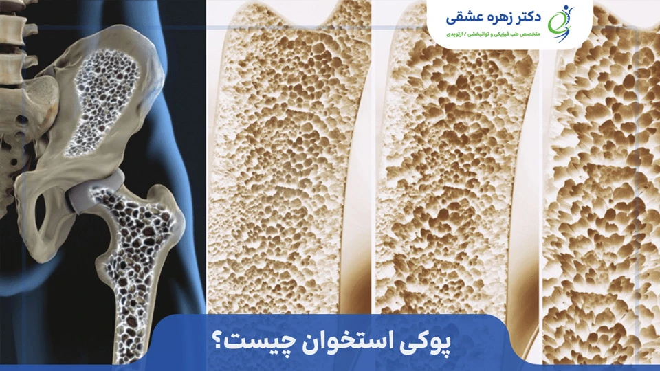 پوکی استخوان چیست