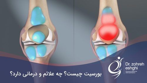 بورسیت چیست