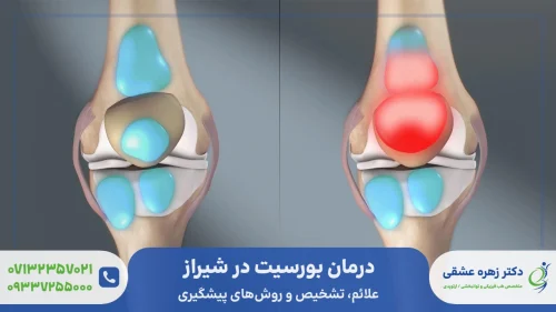 درمان بورسیت در شیراز