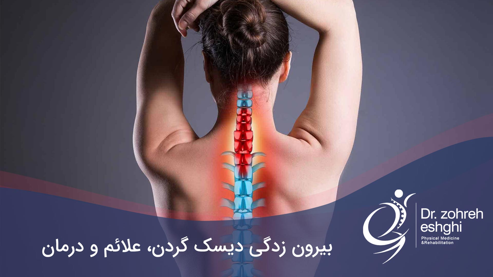 درمان دیسک گردن در شیراز + علائم