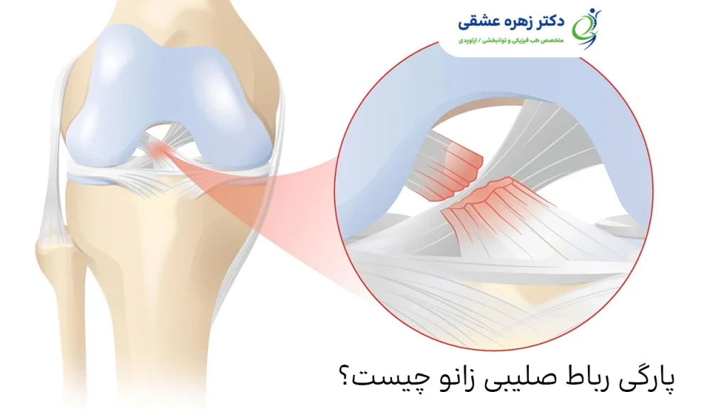 پارگی رباط صلیبی زانو