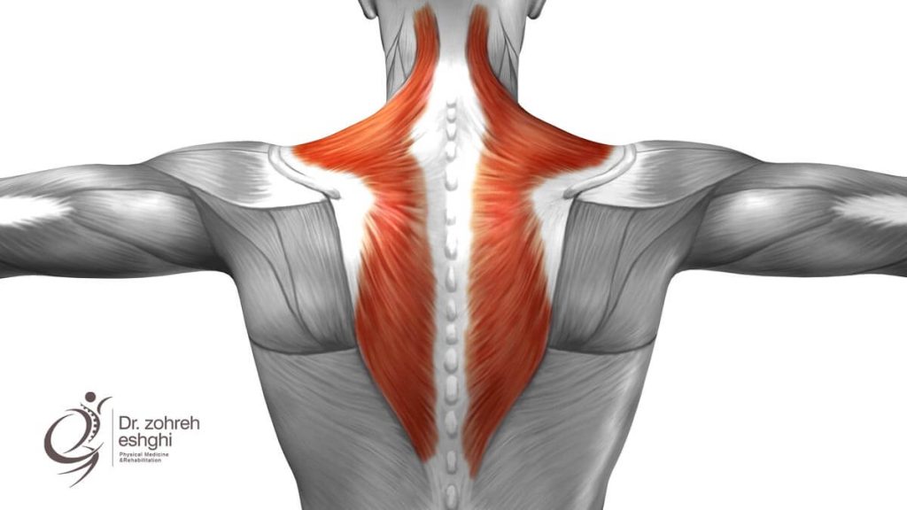 کشیدگی عضله تراپزیوس گردنی