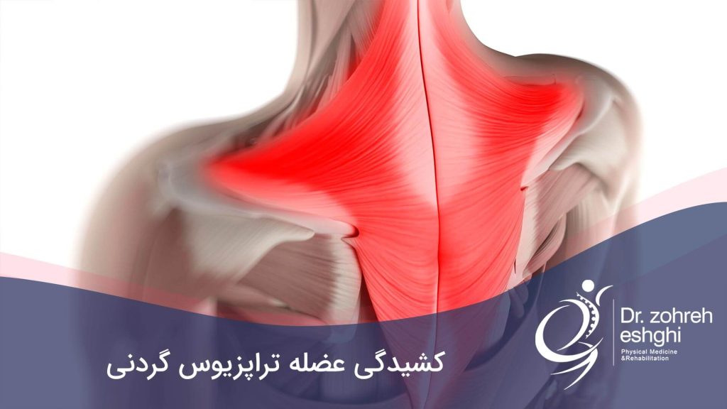 تراپزیوس گردنی
