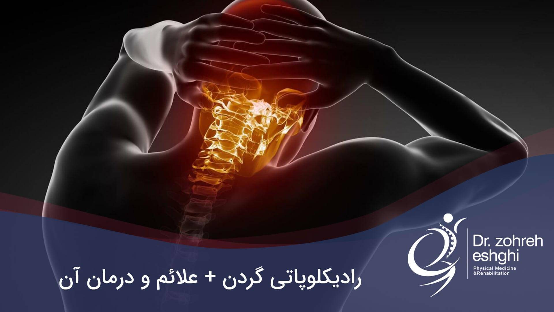 رادیکلوپاتی گردن + علائم و درمان در شیراز