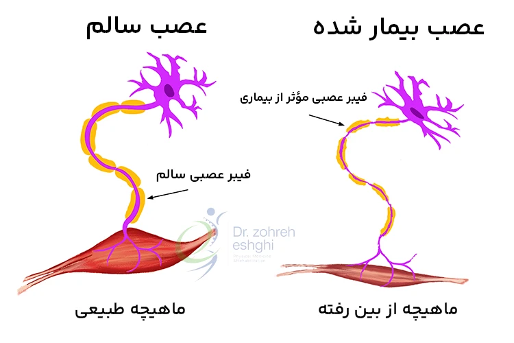 ساختار بیماری موتور نورون یا نورون حرکتی (عصب بیمار شده)