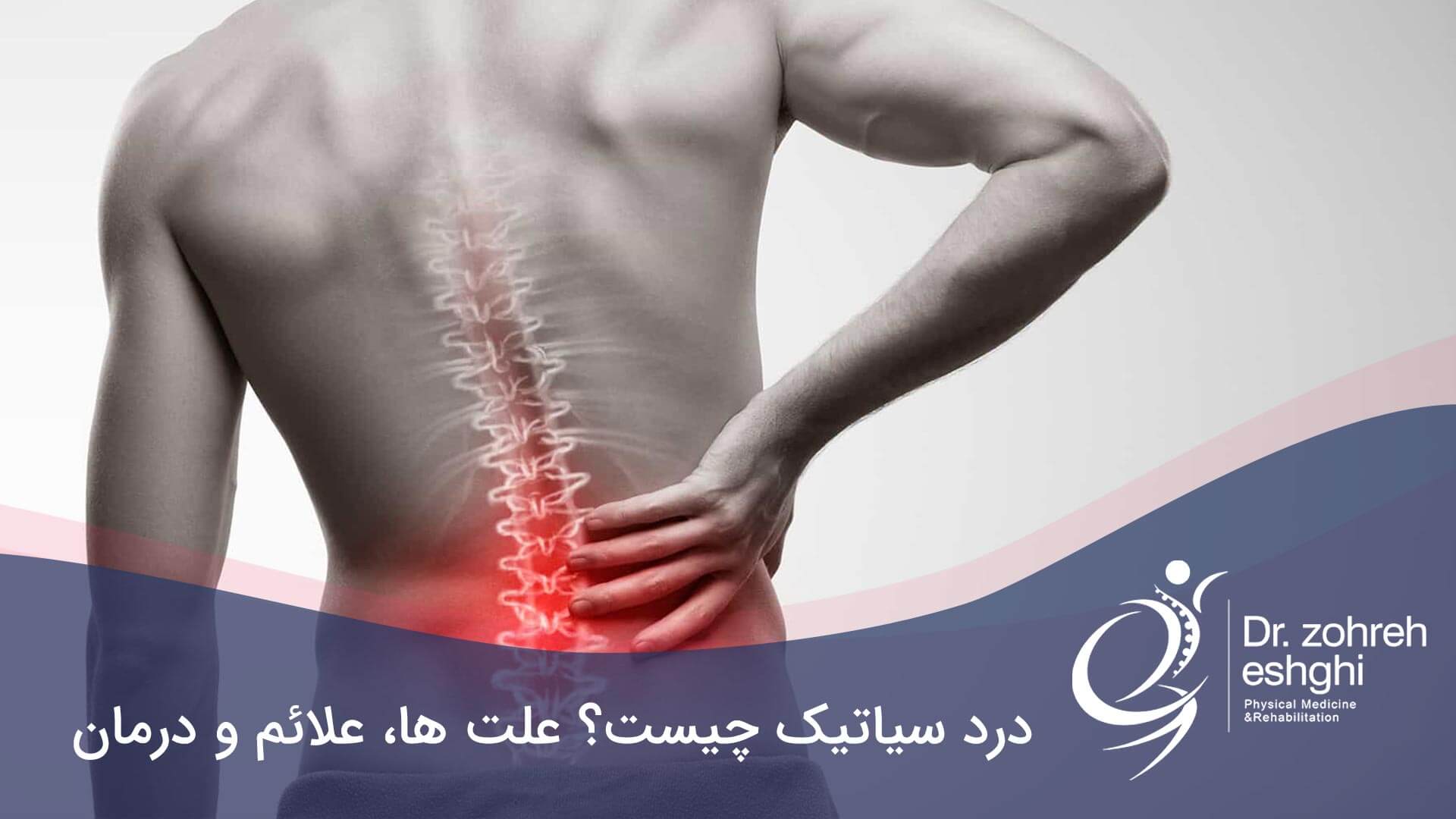 درمان درد سیاتیک در شیراز + علائم و علت‌ها