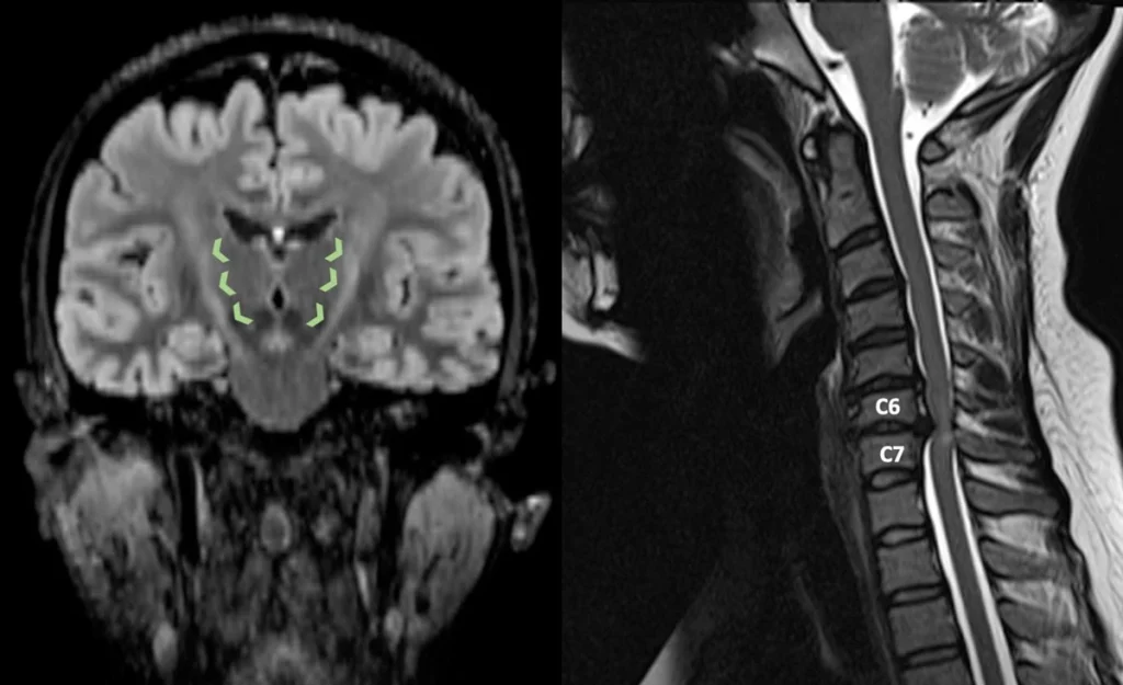 تصویر MRI برای تشخیص نورون حرکتی در ستون فقرات و مغز