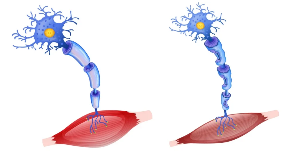 پیشرفت سلول های عصبی بیماری نورون های حرکتی در بیماری ام اس