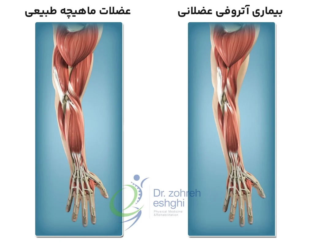 شکل آتروفی عضلانی ماهیچه های بازو