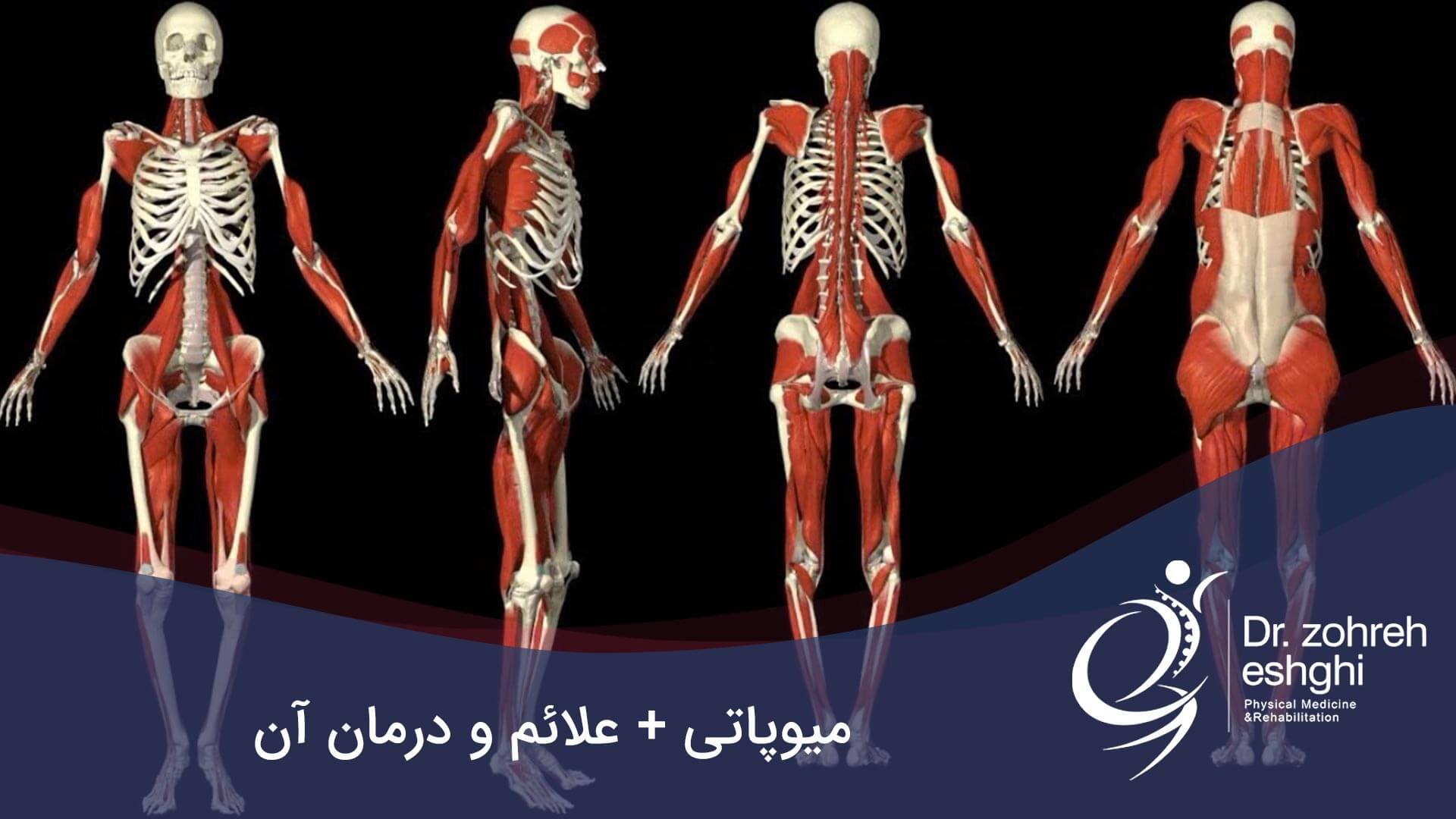 میوپاتی عضلات چیست + علائم و درمان در شیراز