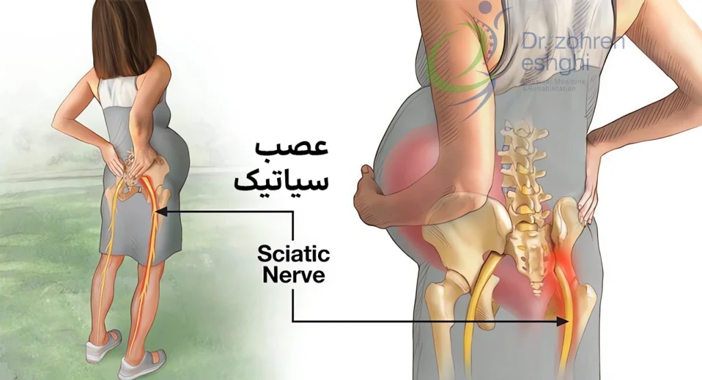 درد سیاتیک در زنان باردار