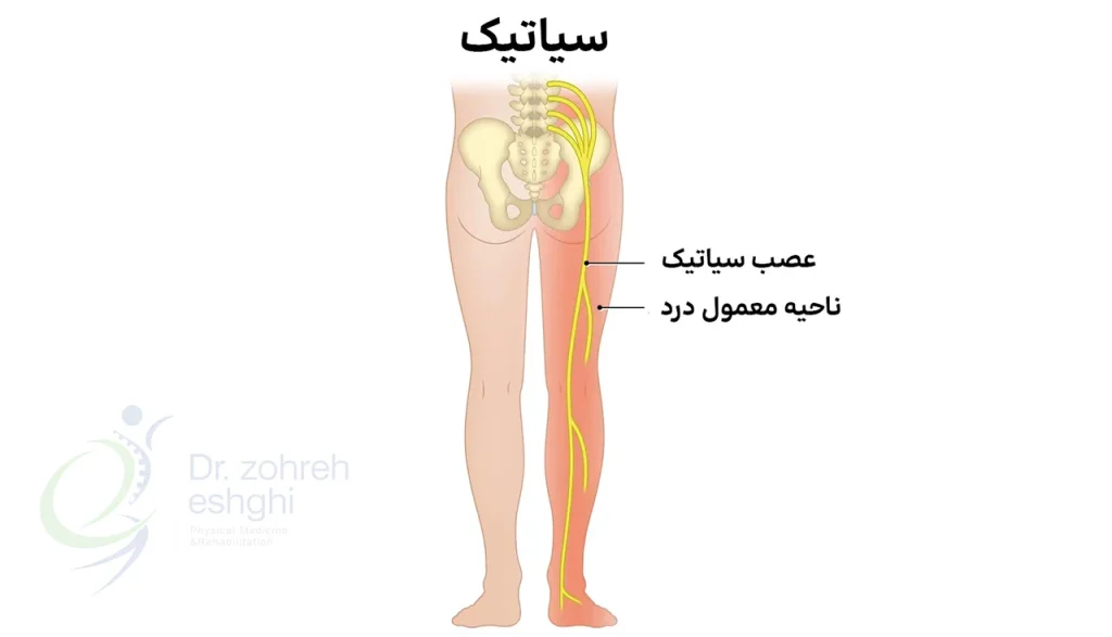 آناتومی ساده عصب سیاتیک