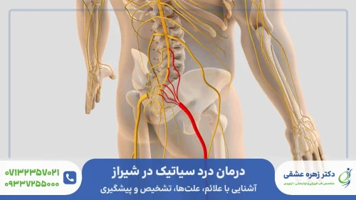 درمان درد سیاتیک در شیراز