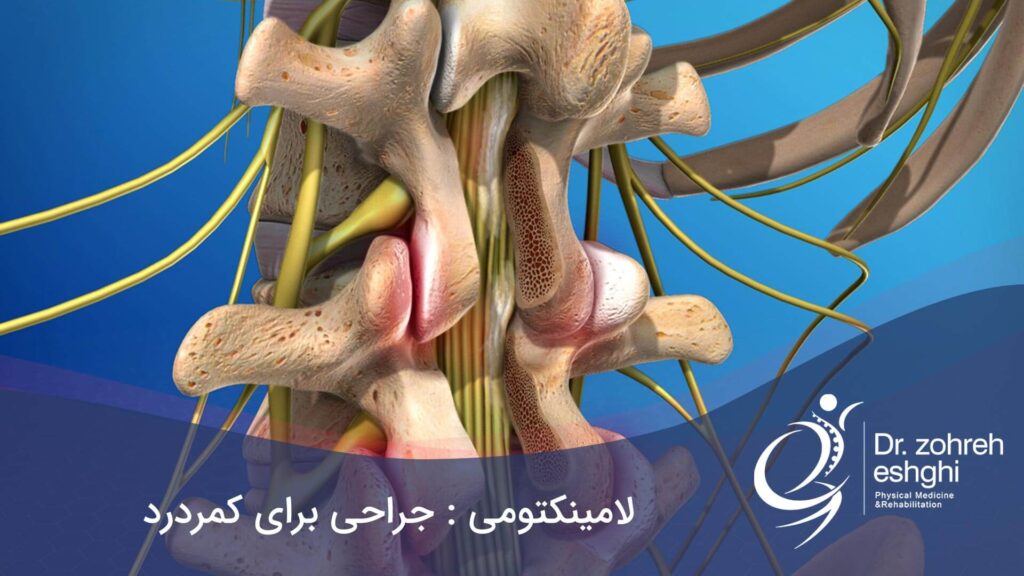 لامینکتومی