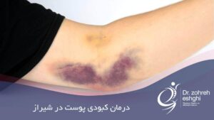 درمان کبودی پوست در شیراز