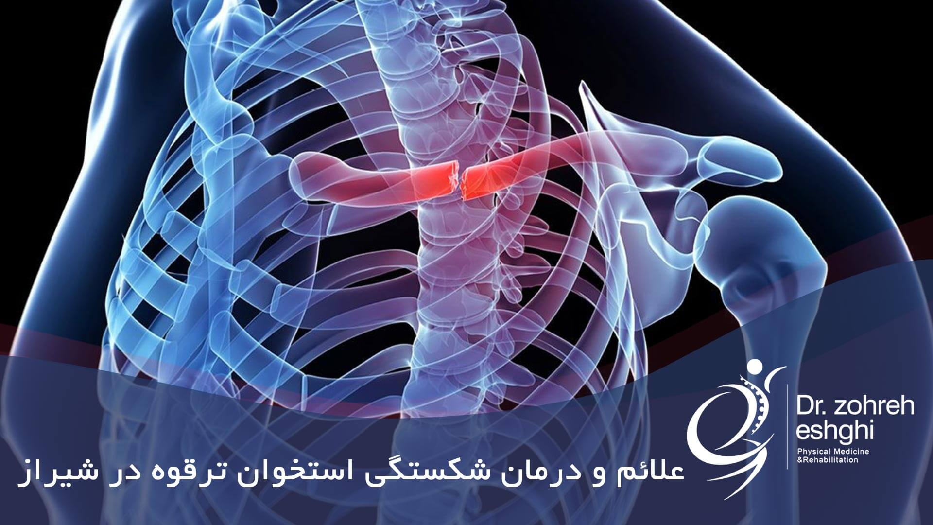 علائم و درمان شکستگی استخوان ترقوه در شیراز