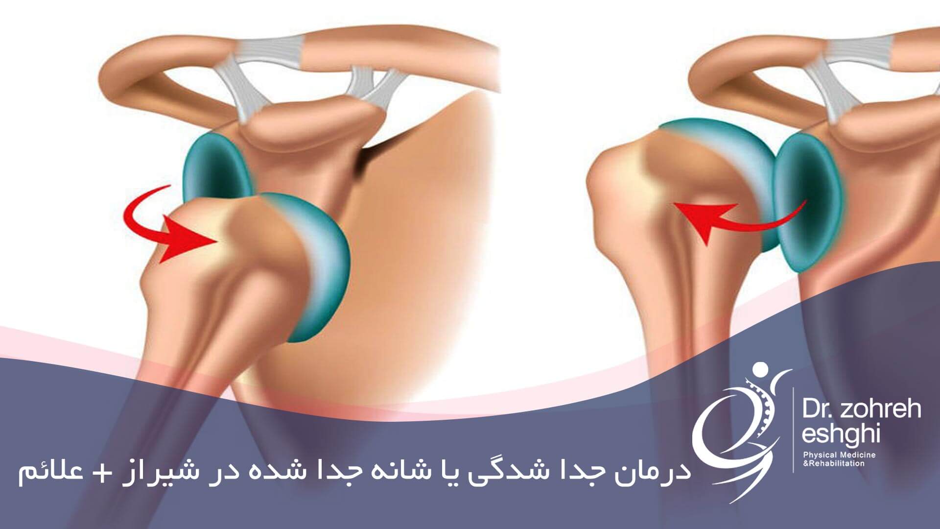 درمان جداشدگی شانه یا شانه جدا شده در شیراز + علائم