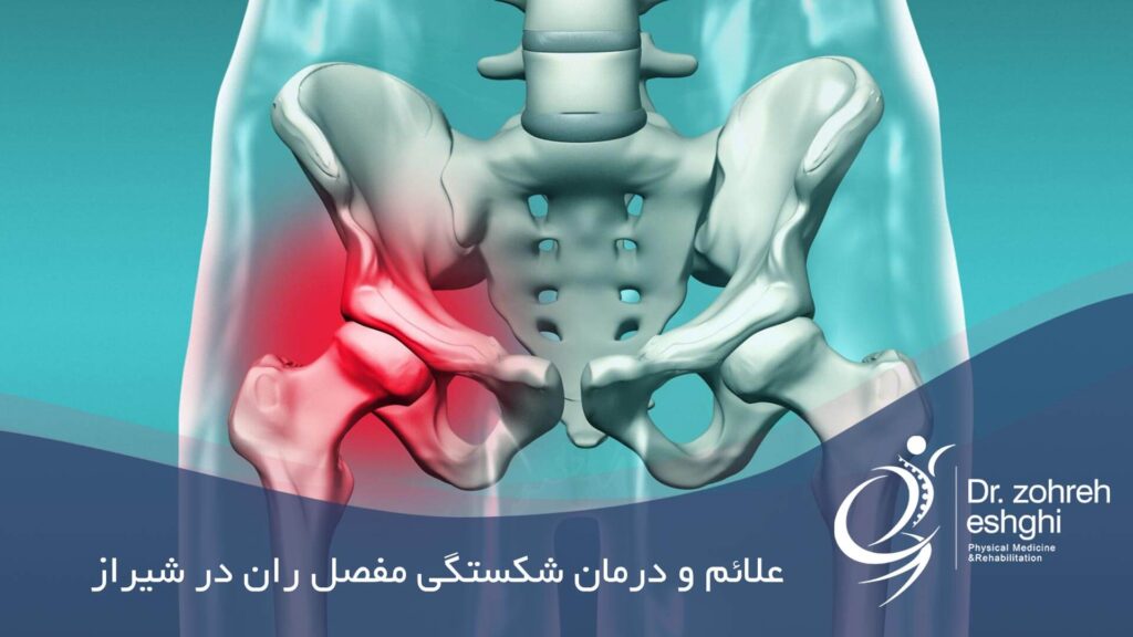 درمان شکستگی مفصل ران