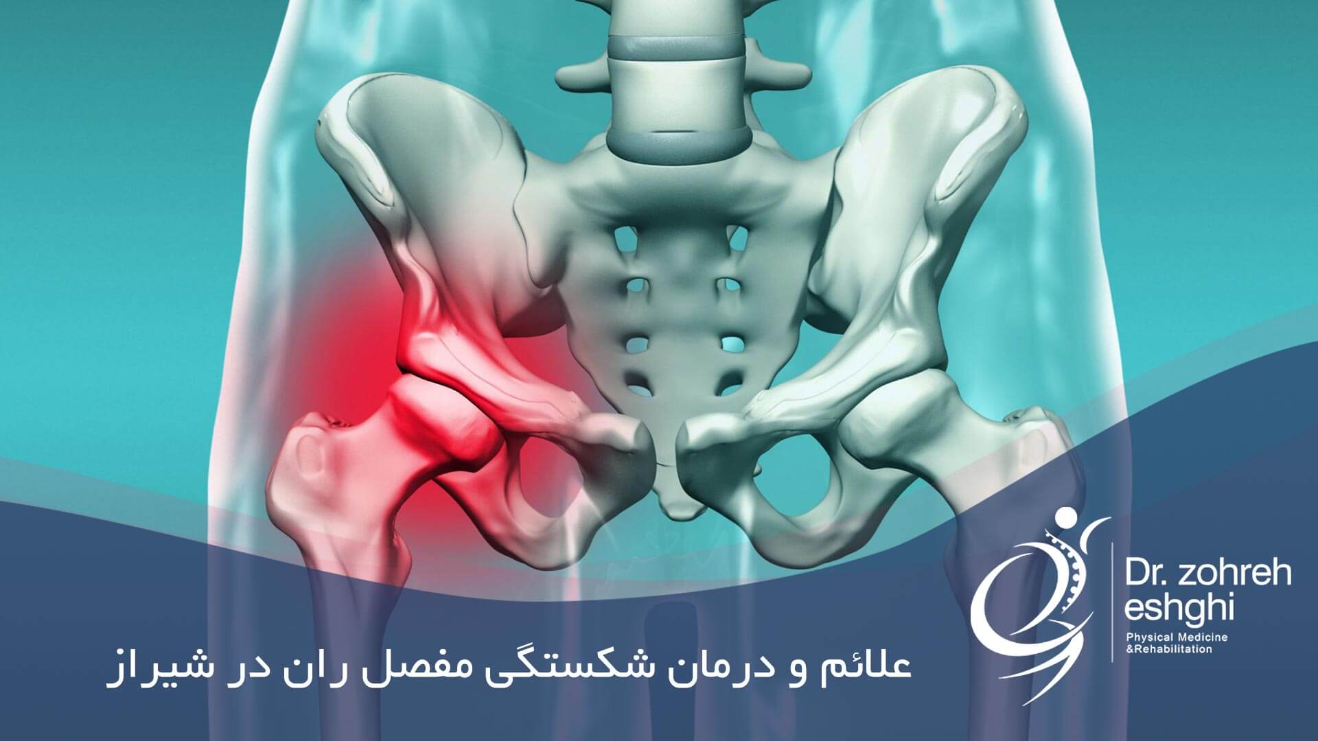 علائم و درمان شکستگی مفصل ران در شیراز
