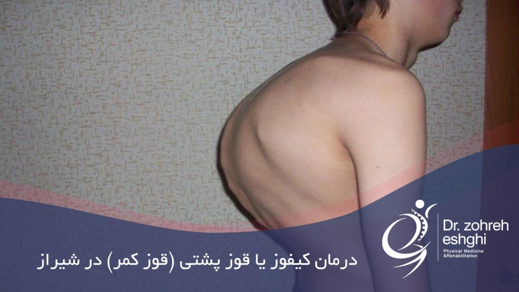 درمان هایپر کیفوز یا قوز پشتی