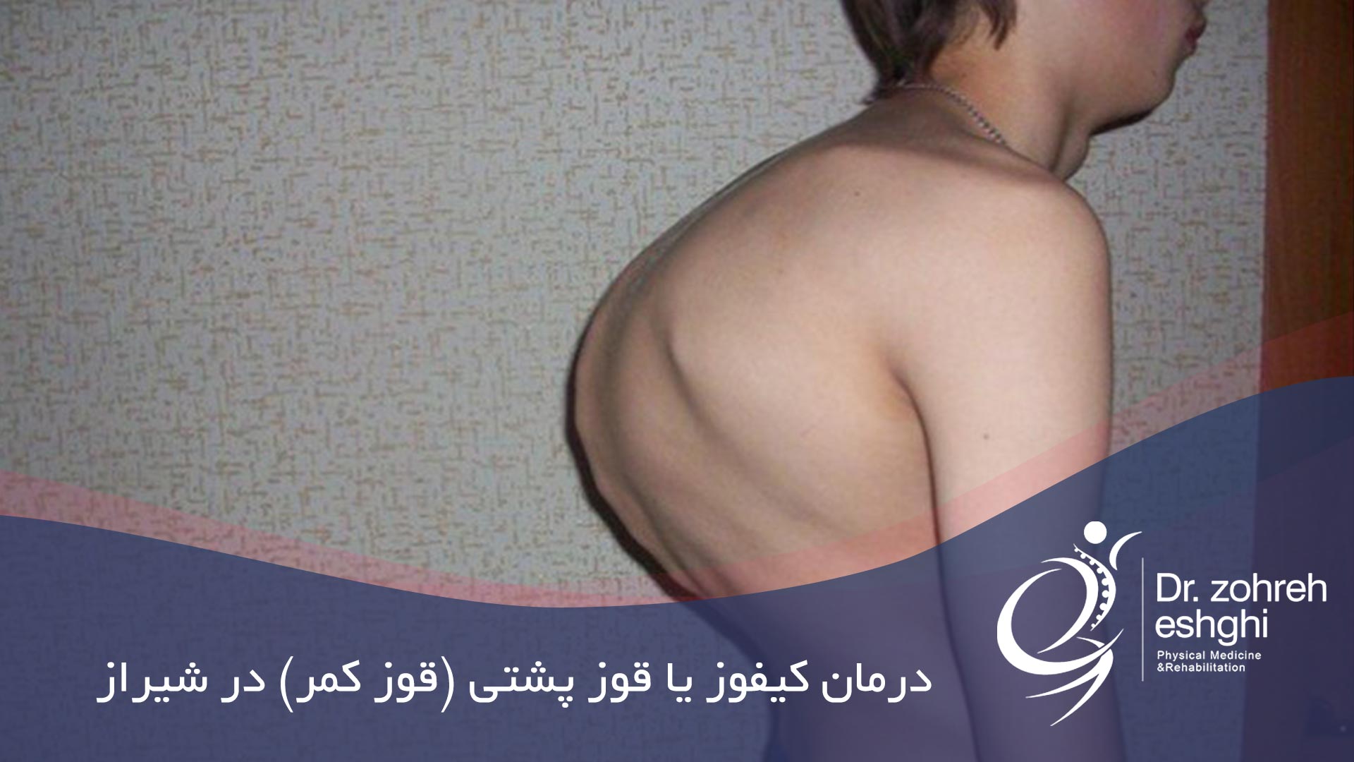 درمان کیفوز یا قوز پشتی (قوز کمر) در شیراز