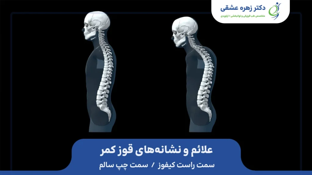 علائم کیفوز ، نشانه های قوز کمر