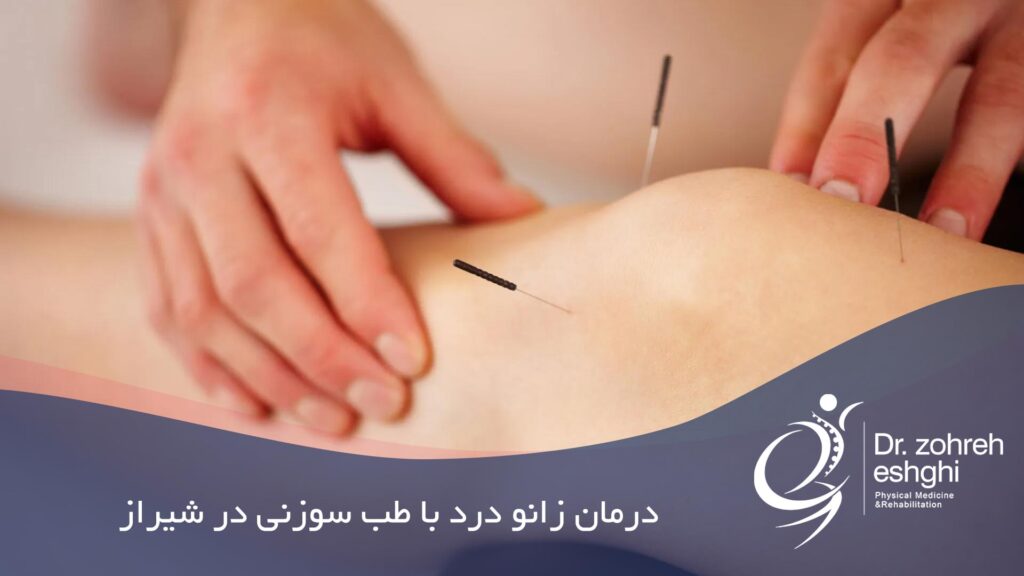طب سوزنی برای درمان زانو درد
