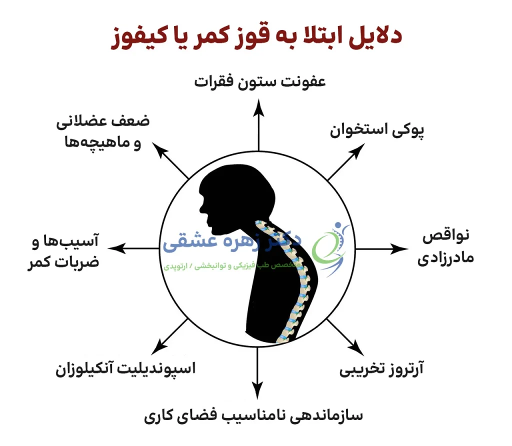 علت های قوز کمر