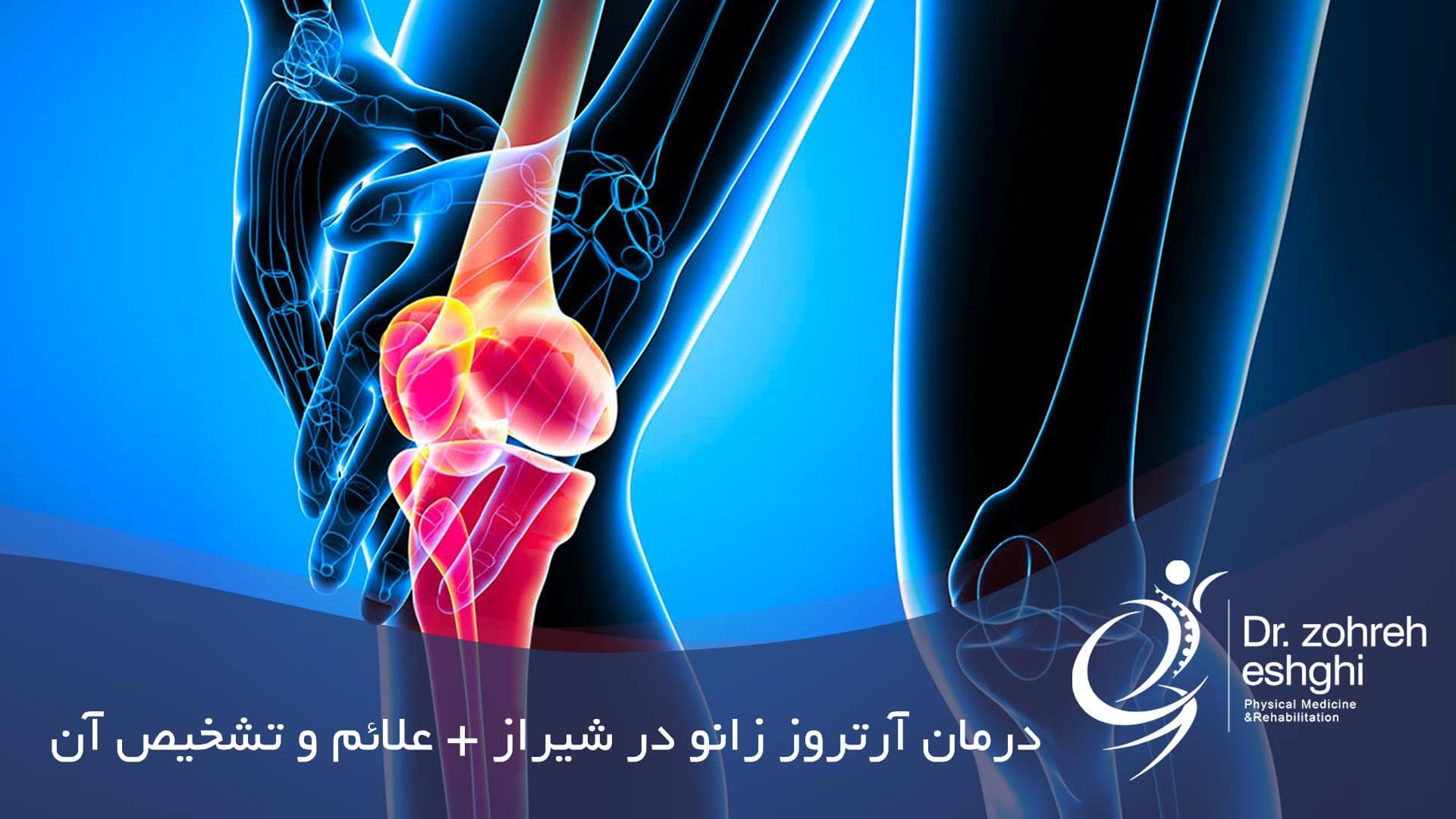 درمان آرتروز زانو در شیراز + تشخیص و علائم آن