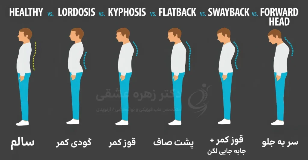 انواع وضعیت نامناسب کمر