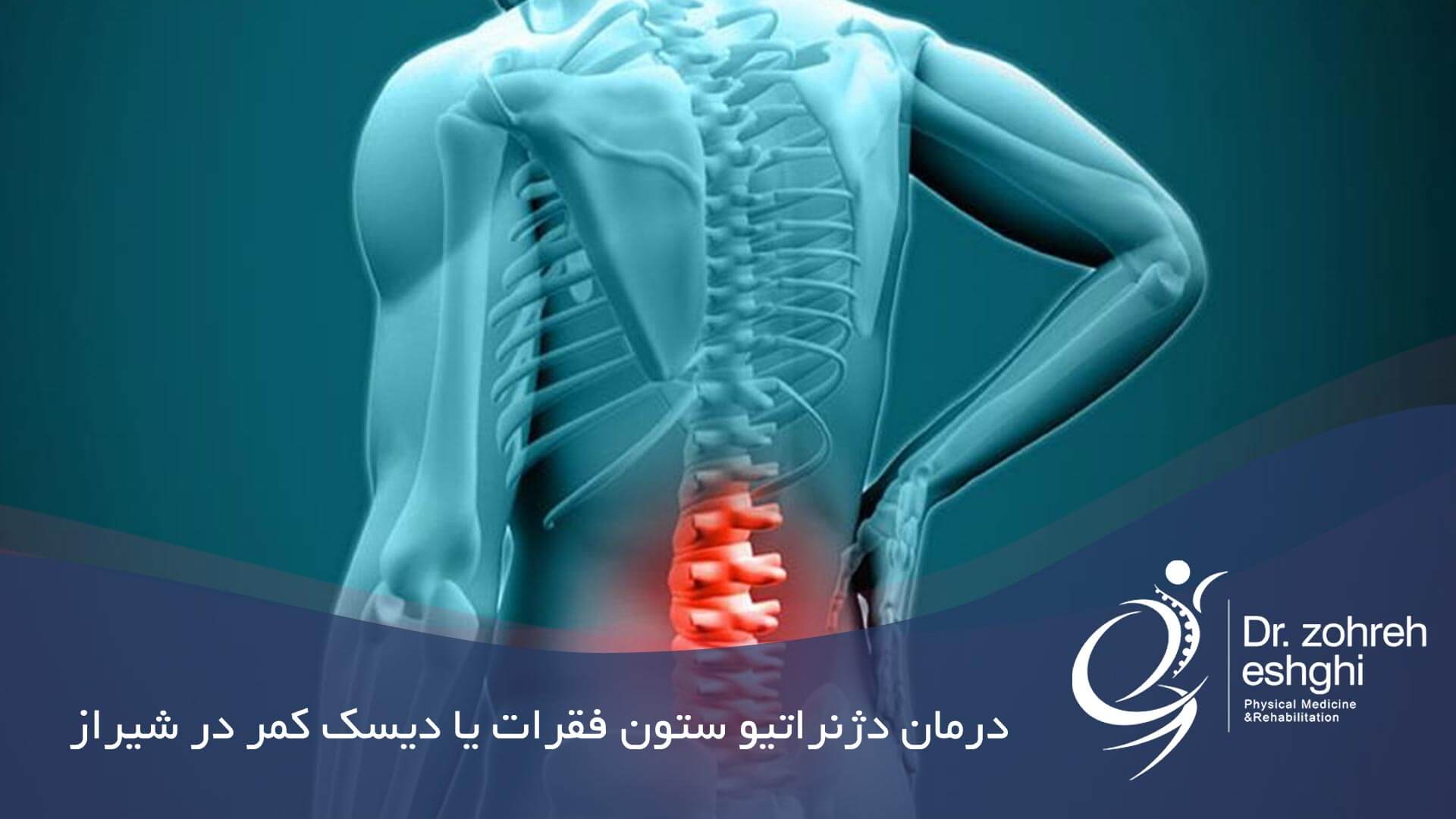 درمان دژنراتیو ستون فقرات در شیراز