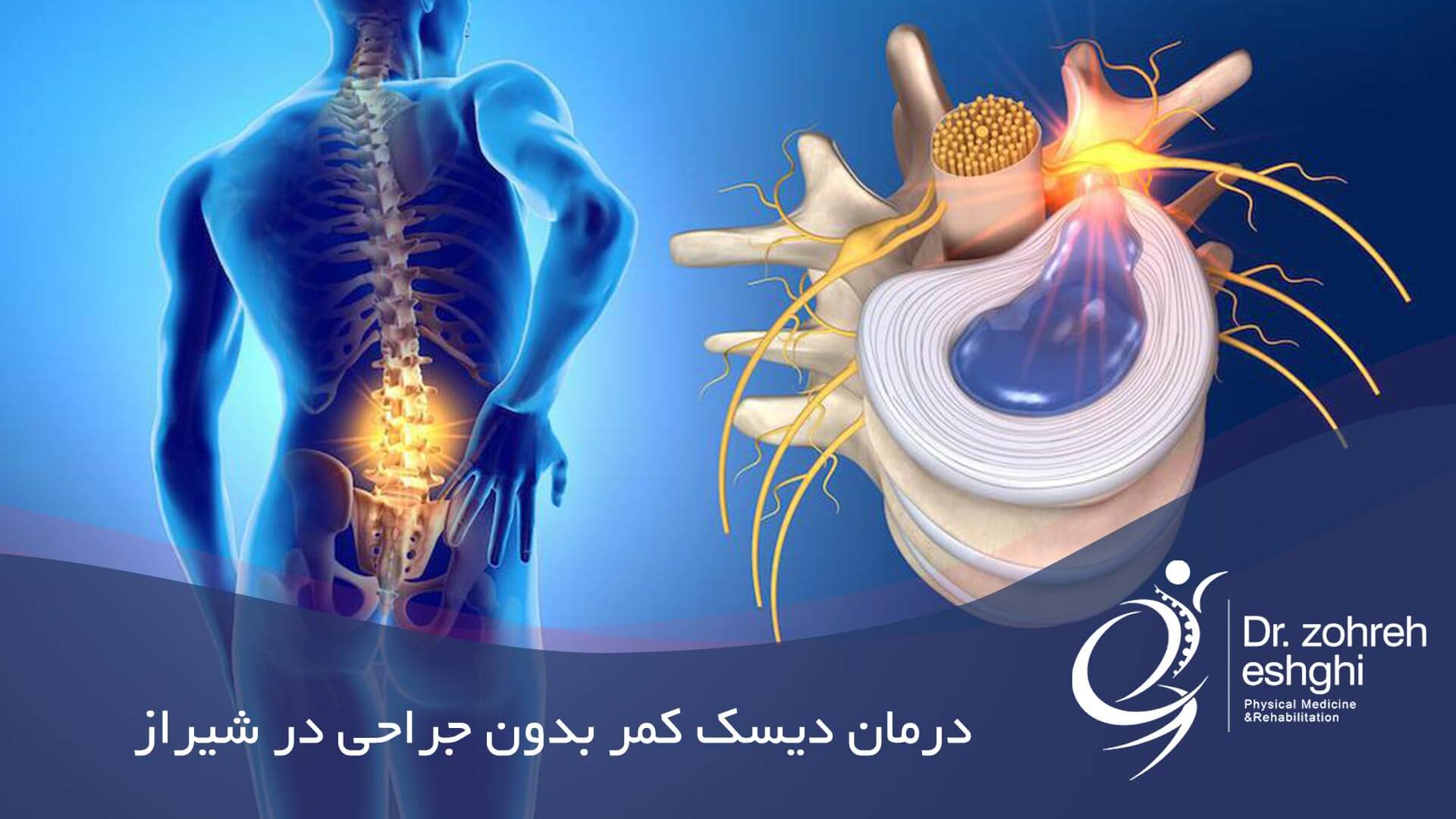 درمان دیسک کمر بدون جراحی در شیراز