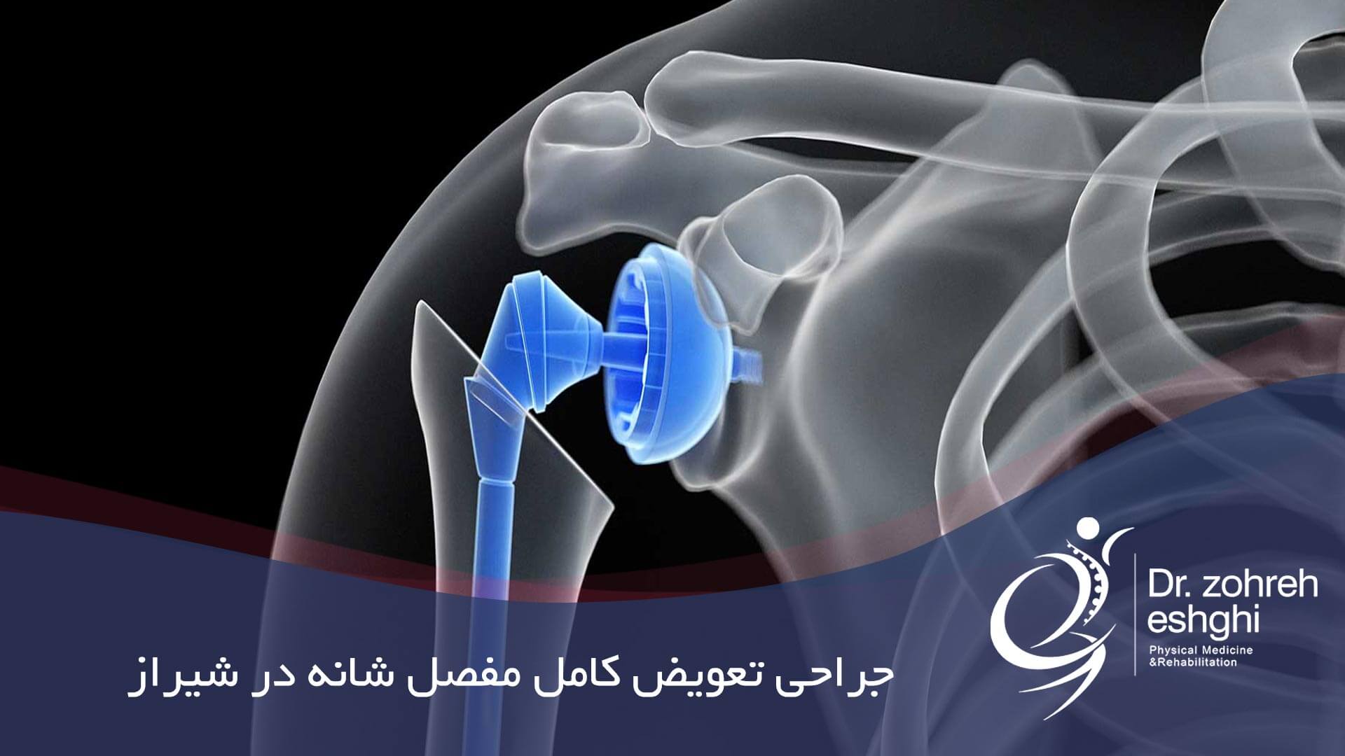 جراحی تعویض کامل مفصل شانه در شیراز