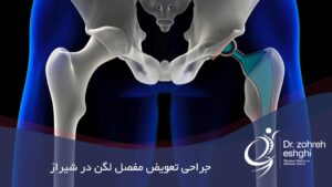 جراحی تعویض لگن در شیراز