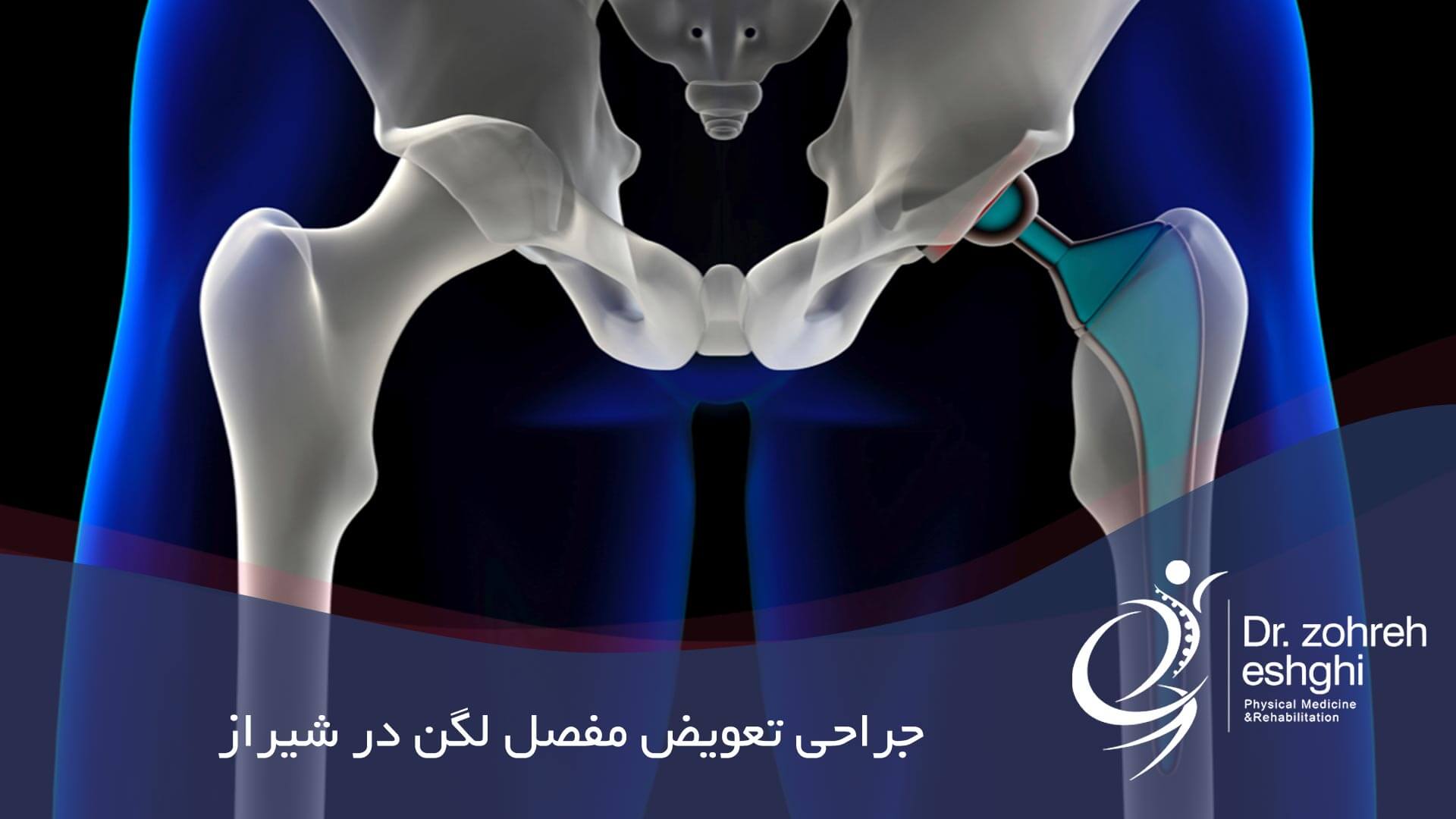 جراحی تعویض مفصل لگن در شیراز
