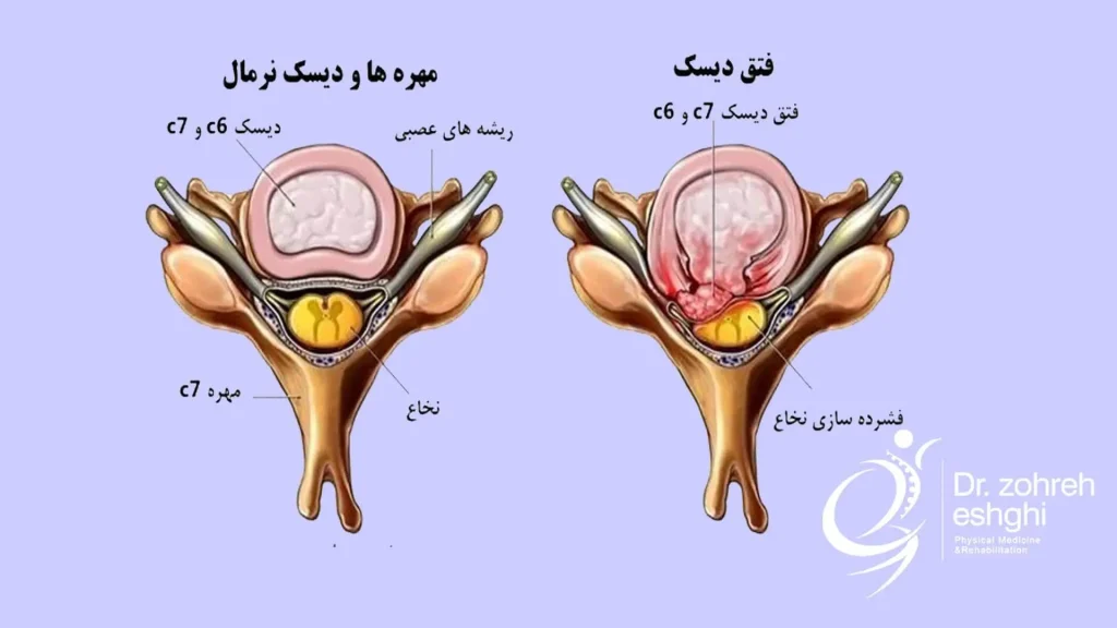 آناتومی فتق دیسک کمر
