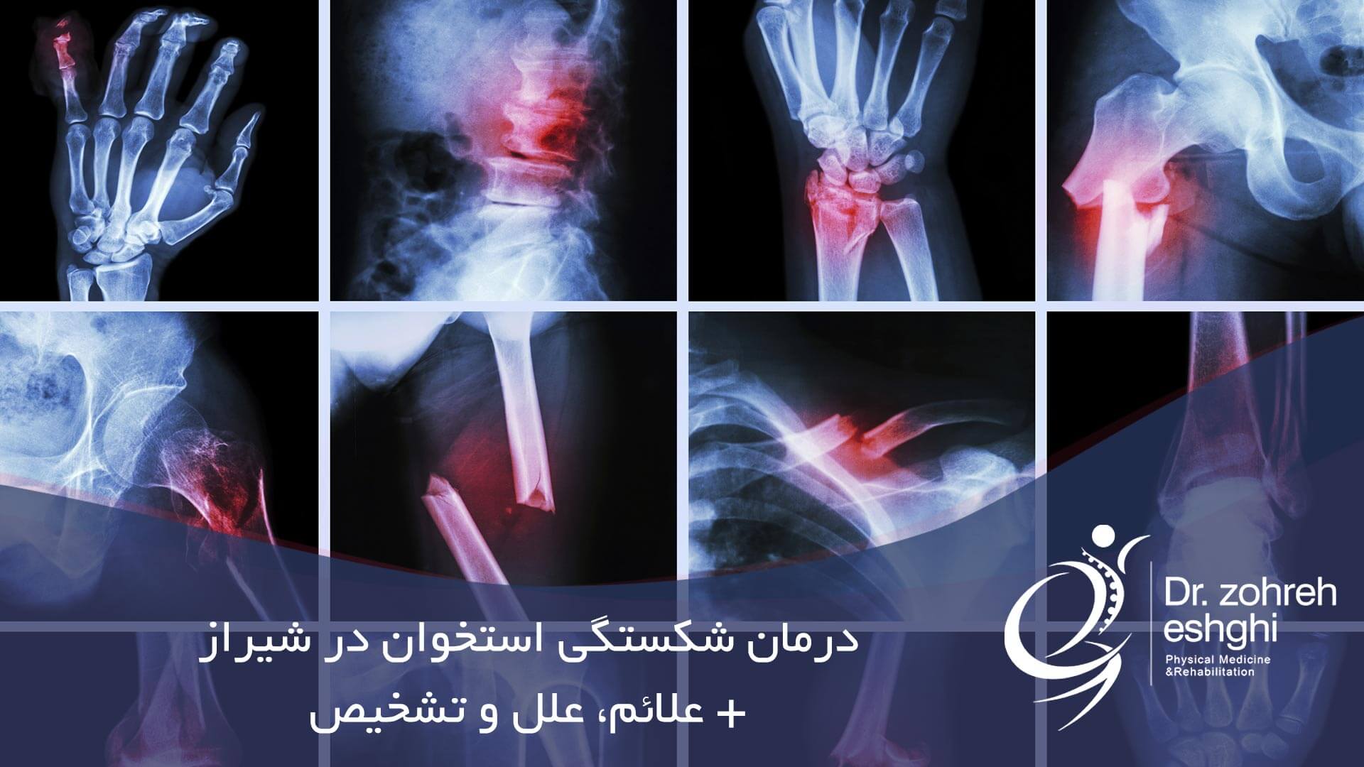 درمان شکستگی استخوان در شیراز + علائم، علل و تشخیص