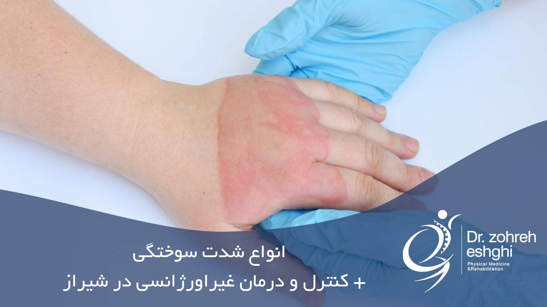 انواع شدت سوختگی + کنترل و درمان غیراورژانسی در شیراز