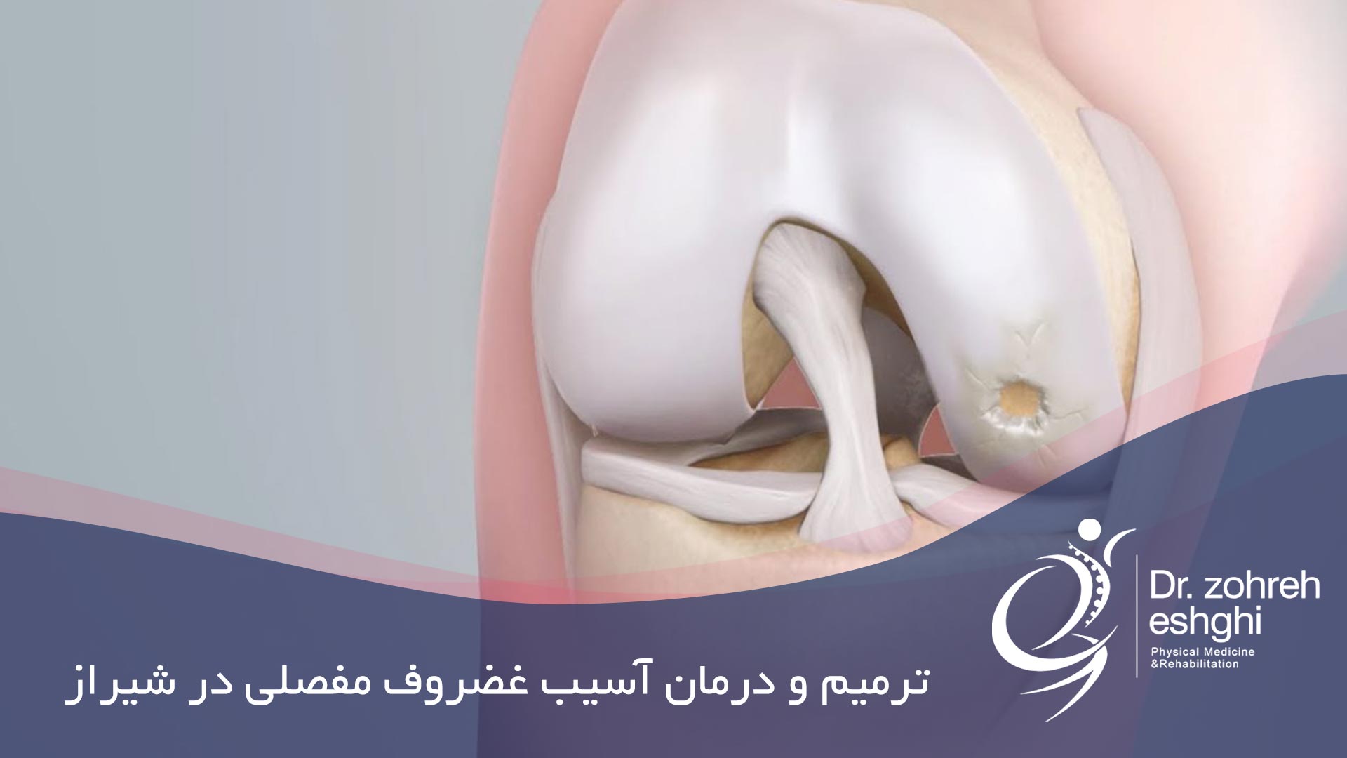 ترمیم و درمان آسیب غضروف مفصلی در شیراز