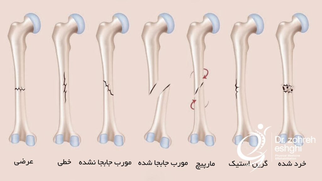 انواع شکستگی استخوان