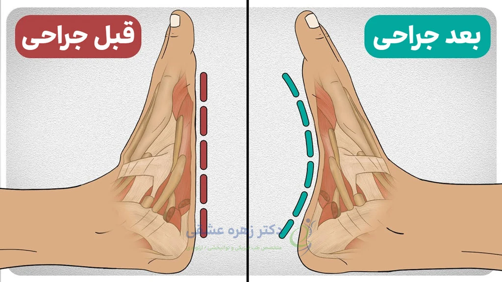 نتیجه قبل و بعد از جراحی صافی کف پا
